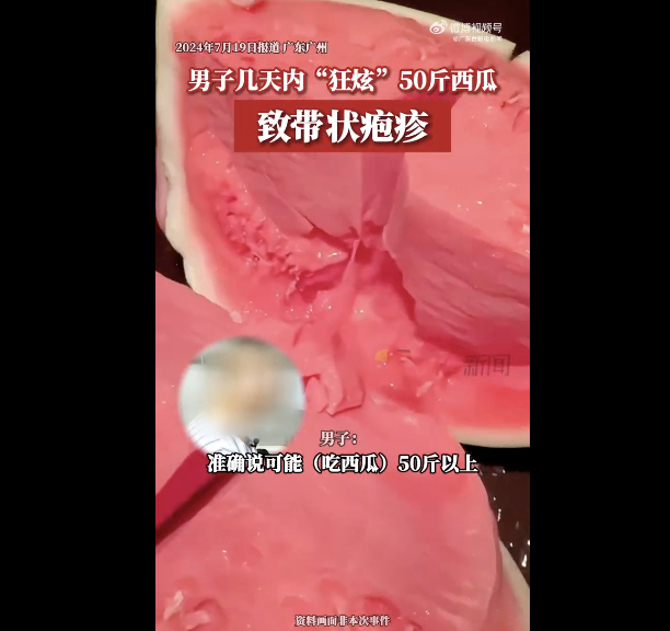 万万没想到！男子几天内狂炫50斤西瓜致带状疱疹 